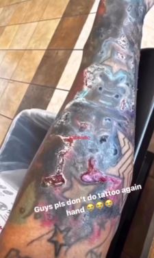 VIDEO: Please Don’t Do Tattoo – Man Warns After Suffering Severe Skin Reaction