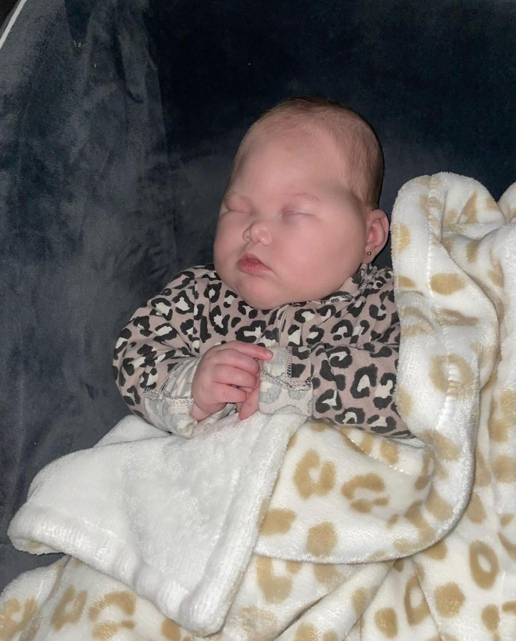 Doctors surprised that "Miracle" Baby born without eyes and had half her brain removed is 