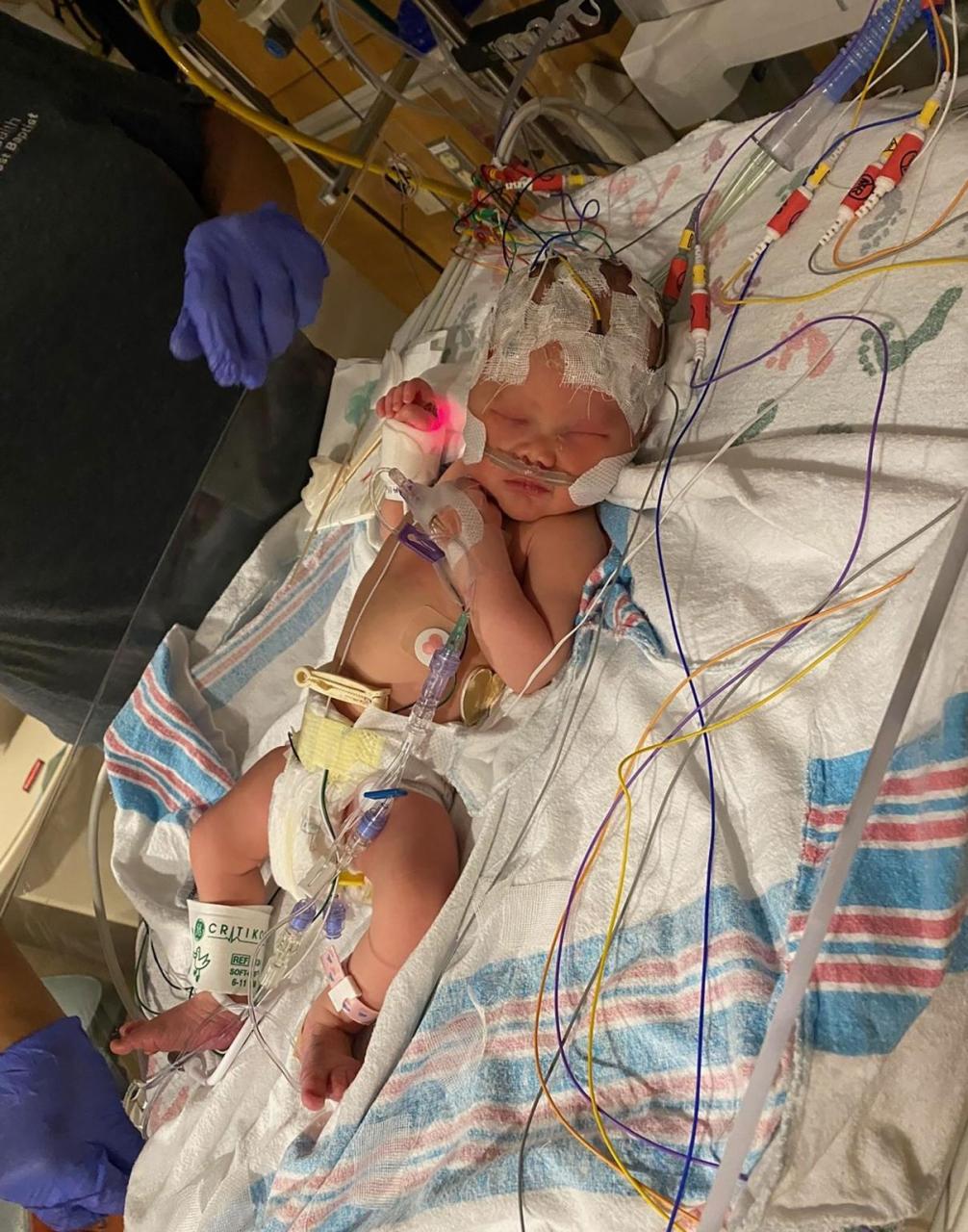 Doctors surprised that "Miracle" Baby born without eyes and had half her brain removed is 