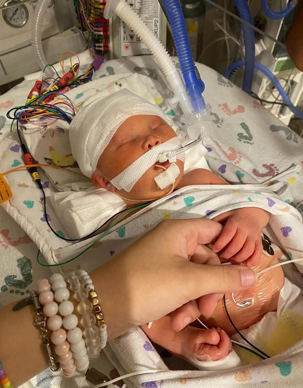 Doctors surprised that "Miracle" Baby born without eyes and had half her brain removed is 