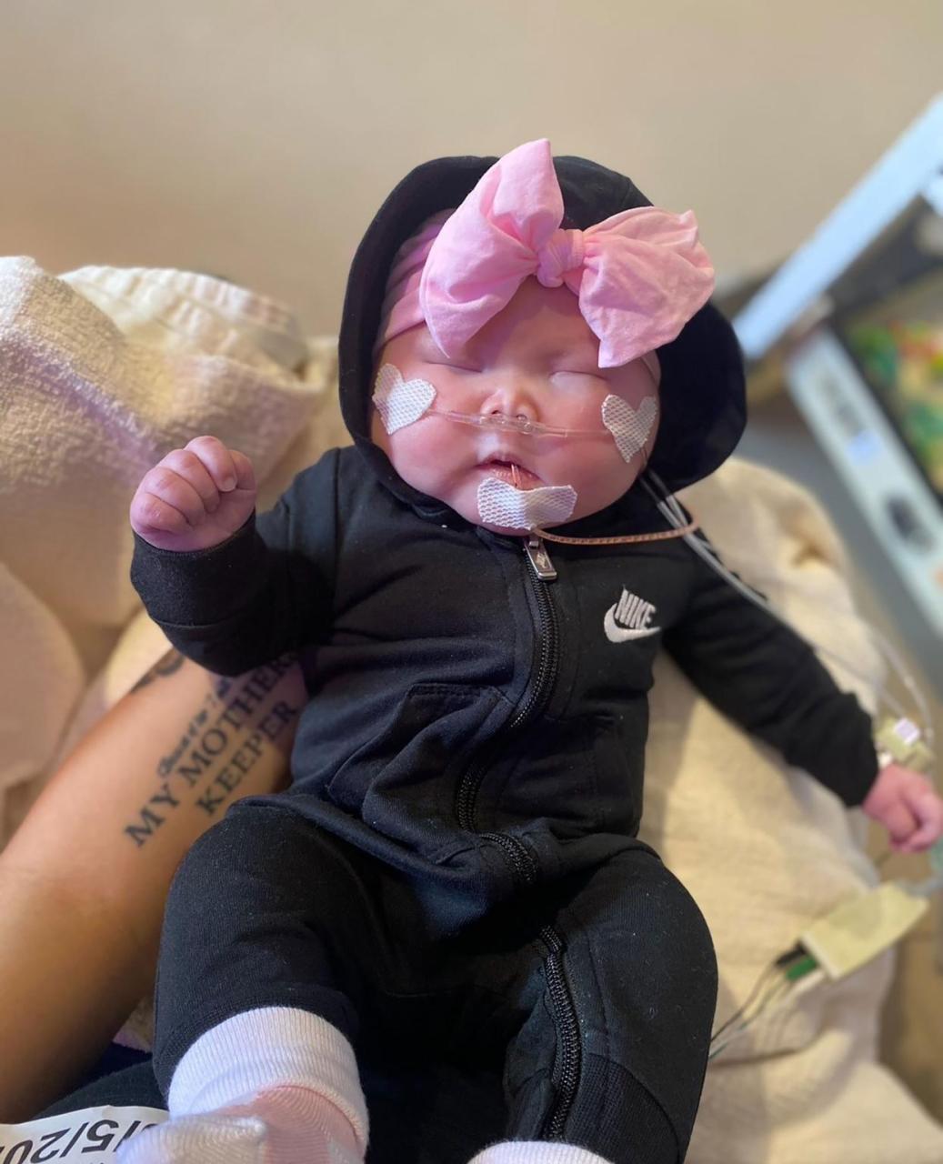 Doctors surprised that "Miracle" Baby born without eyes and had half her brain removed is 