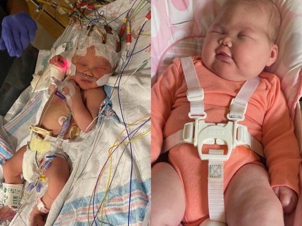 Doctors surprised that “Miracle” Baby born without eyes and had half her brain removed is ‘living and growing well’ (photos)