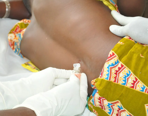 FG warns of Meningitis outbreak in Nigeria