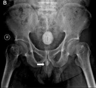 Man, 48, left in agony after sticking sim card extractor tool, electrical cable and rubber band into his penis