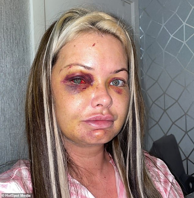 Mother-of-three shares images of her horrific facial injuries after she was attacked by her boyfriend