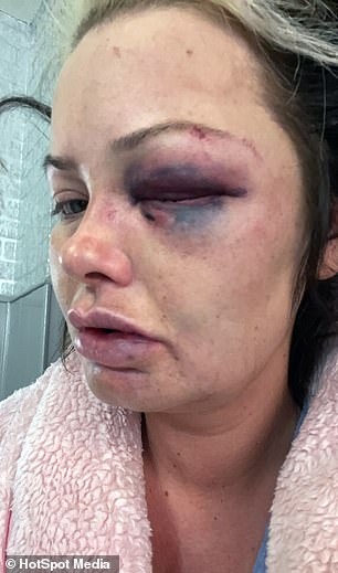 Mother-of-three shares images of her horrific facial injuries after she was attacked by�her�boyfriend