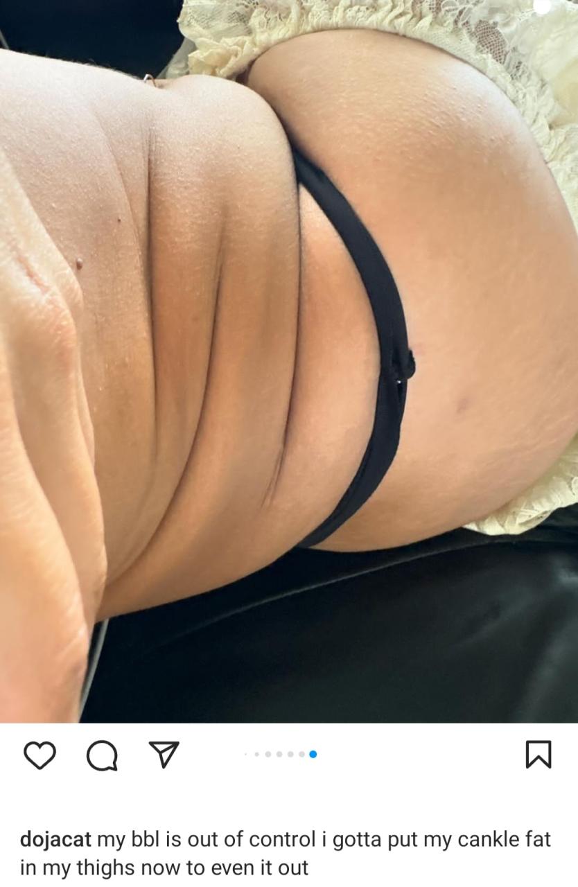 Singer, Doja Cat laments that her BBL has gone out of control