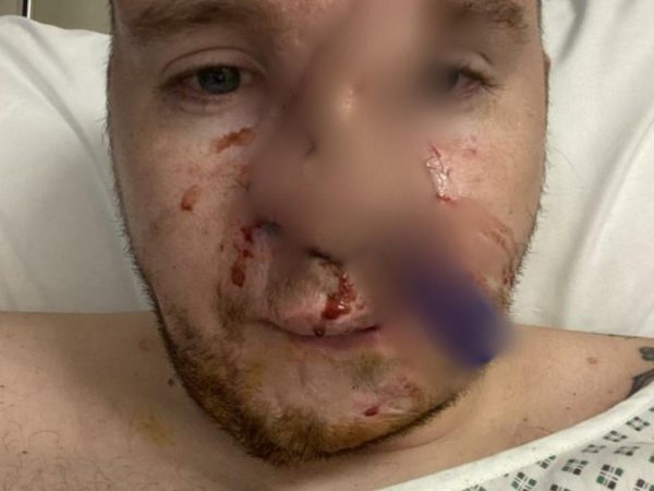 Man’s ribs used to rebuild his nose after it was ripped off by his dog