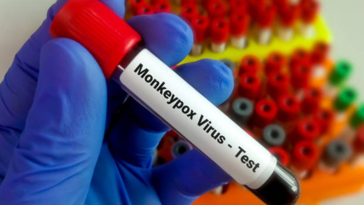People living with HIV/AIDS are at higher risk of contracting monkeypox – NACA issues advisory