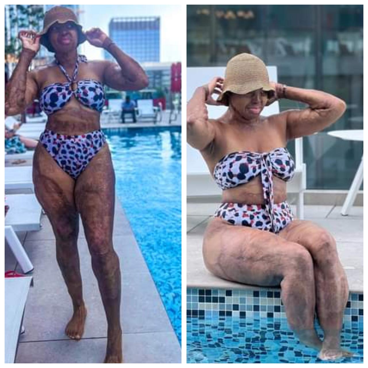 Plane crash survivor, Kechi Okwuchi dons bikini