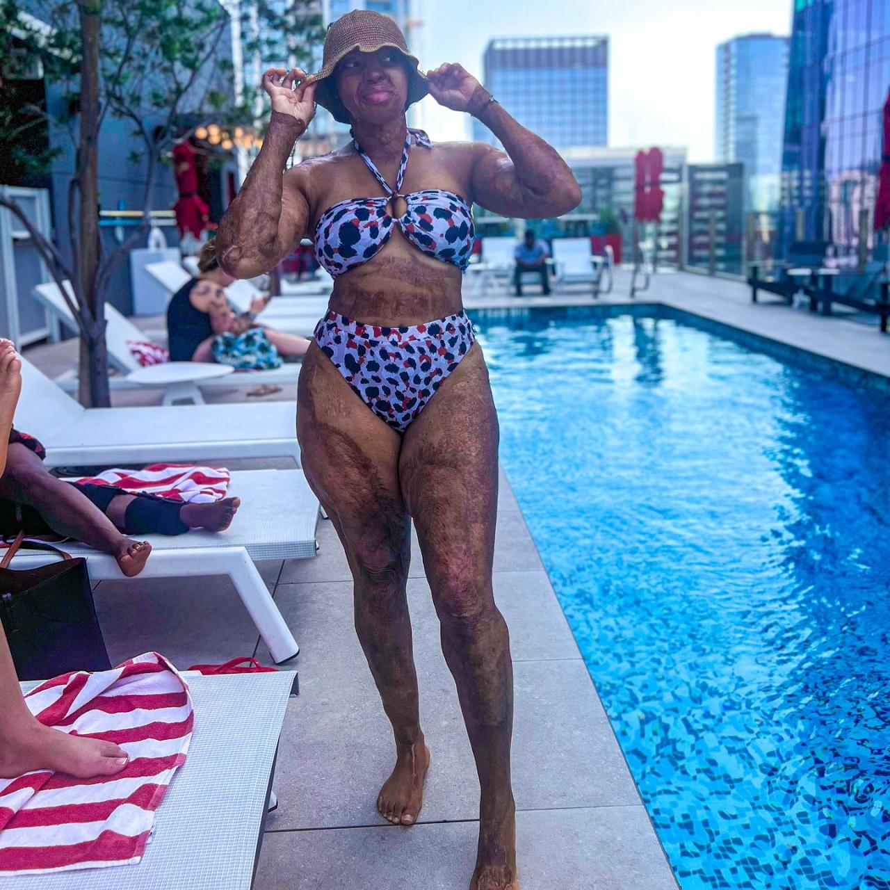 Plane crash survivor, Kechi Okwuchi dons bikini