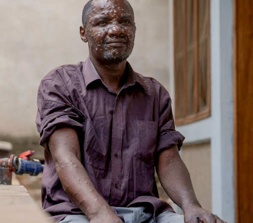 NCDC reports higher Mpox infection among males in Nigeria