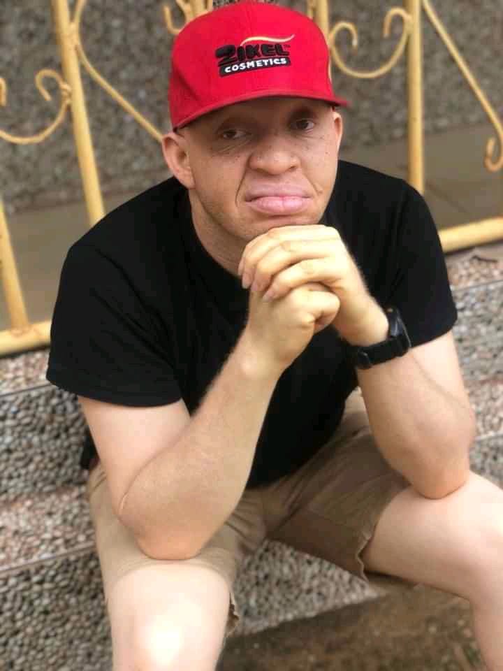 Don’t come near me with that rubbish mentality – Nigerian man warns people who say albinos have Iow self esteem because of their skin color