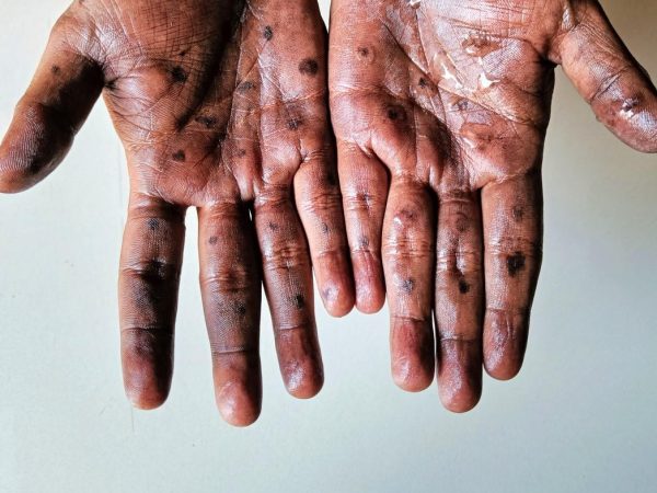 WHO prequalifies vaccine for monkeypox for the first time
