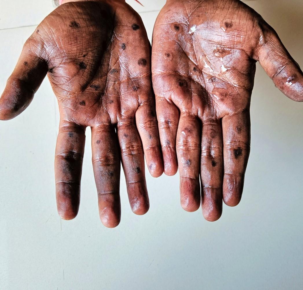 WHO prequalifies vaccine for monkeypox for the first time