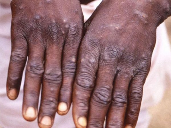 Ghana confirms first case of monkeypox in 2024