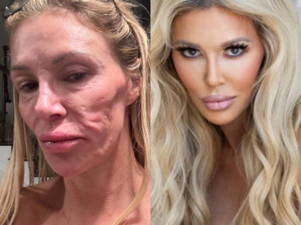 TV personality, Brandi Glanville shares troubling photo of her face as she opens up about health battle